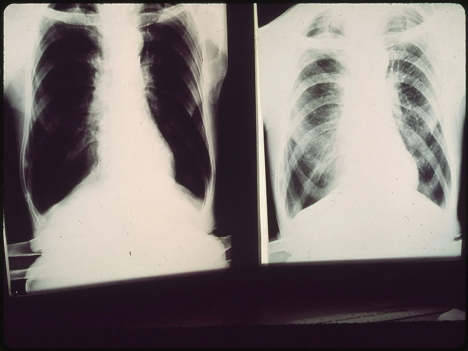 BLACK LUNG X RAYS Woodson LeRoy U S National Archives and Records Administration